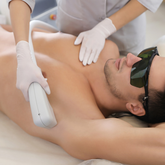 Laser-Haarentfernung am Körper